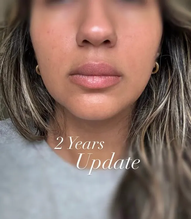 Dark Lips Neutralization result by New Face by Christine, NYC — photo 122