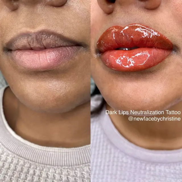 Dark Lips Neutralization result by New Face by Christine, NYC — photo 123