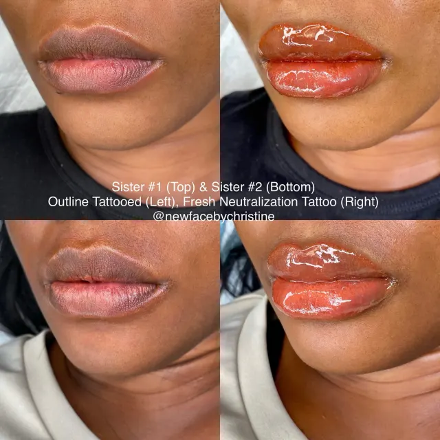 Dark Lips Neutralization result by New Face by Christine, NYC — photo 124