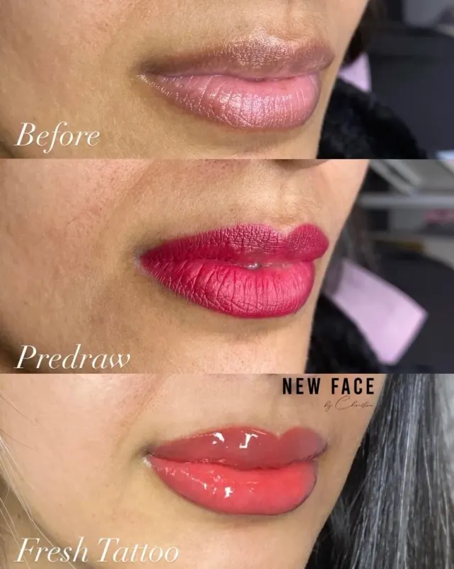 Dark Lips Neutralization result by New Face by Christine, NYC — photo 125