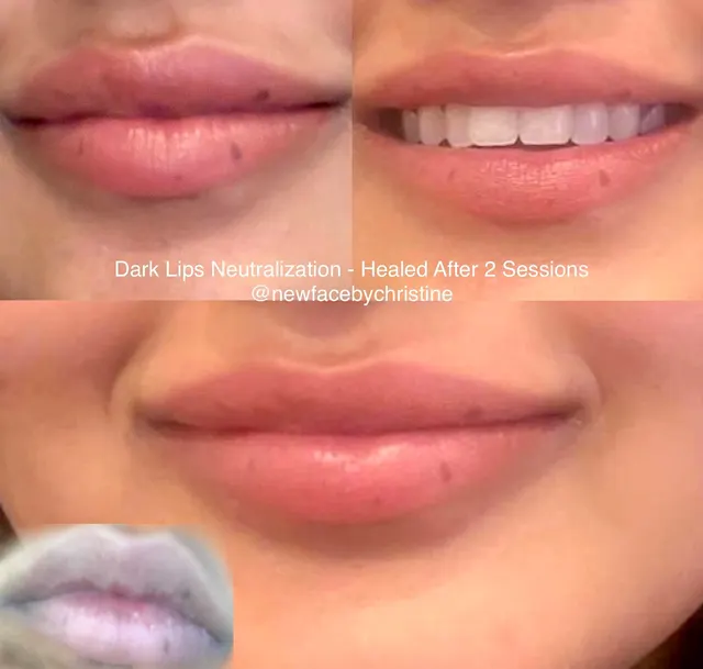 Dark Lips Neutralization result by New Face by Christine, NYC — photo 127