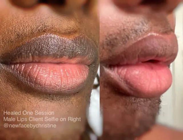 Dark Lips Neutralization result by New Face by Christine, NYC — photo 128