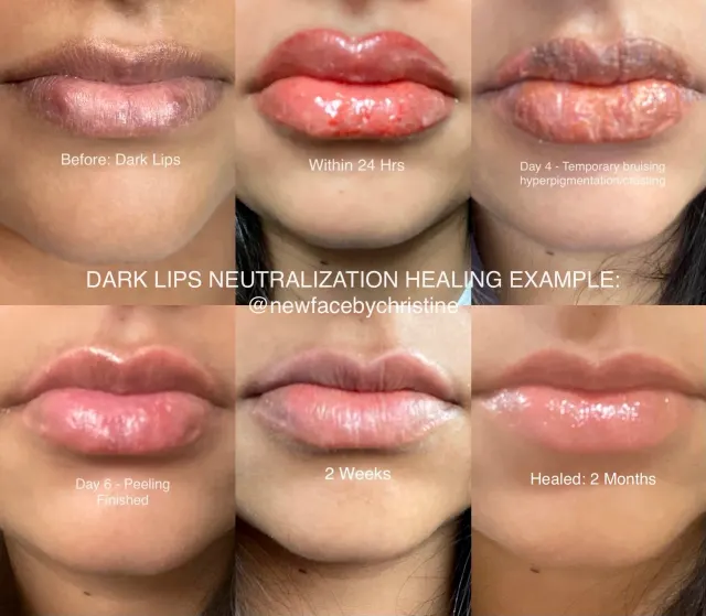 Dark Lips Neutralization result by New Face by Christine, NYC — photo 130