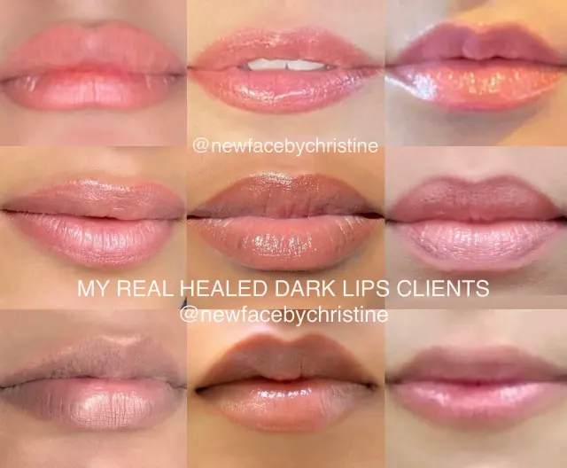 Dark Lips Neutralization result by New Face by Christine, NYC — photo 133
