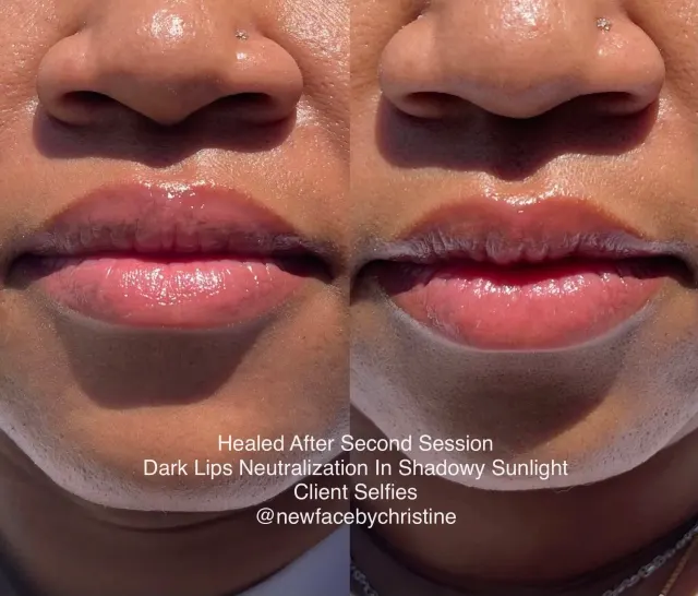 Dark Lips Neutralization result by New Face by Christine, NYC — photo 134