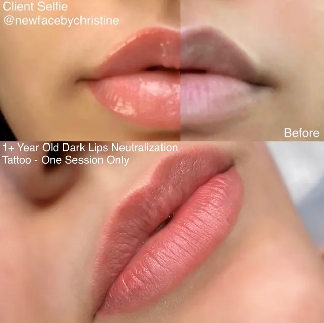 Dark Lips Neutralization result by New Face by Christine, NYC — photo 135