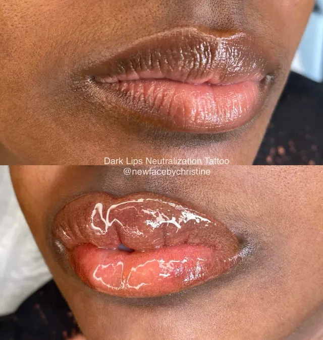 Dark Lips Neutralization result by New Face by Christine, NYC — photo 136