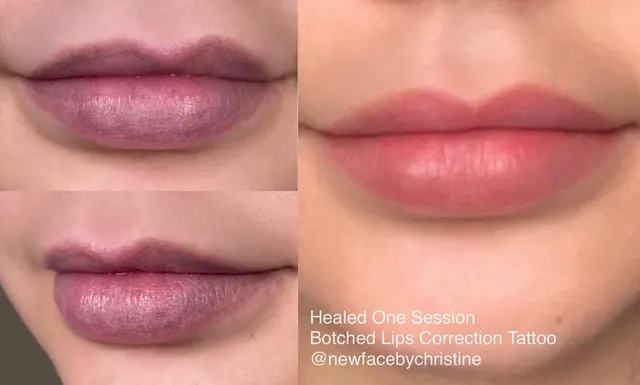 Dark Lips Neutralization result by New Face by Christine, NYC — photo 137