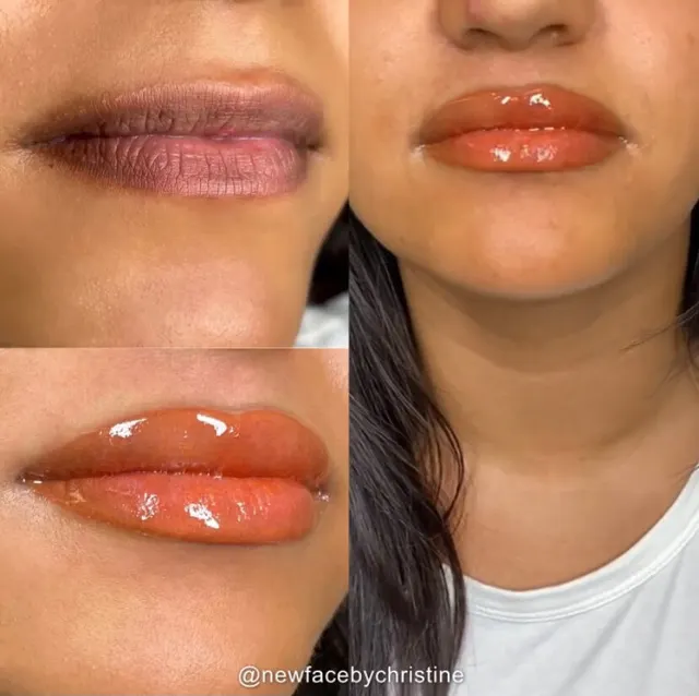 Dark Lips Neutralization result by New Face by Christine, NYC — photo 140