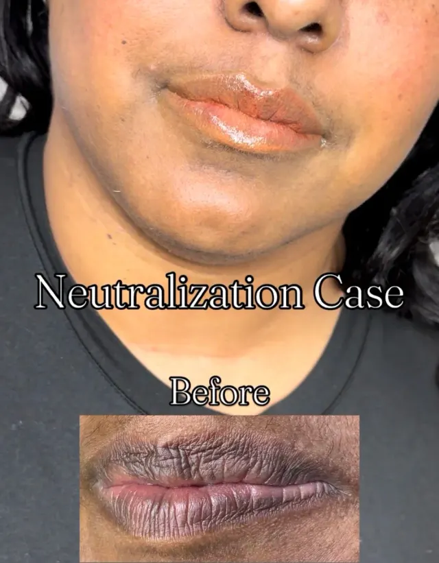 Dark Lips Neutralization result by New Face by Christine, NYC — photo 143