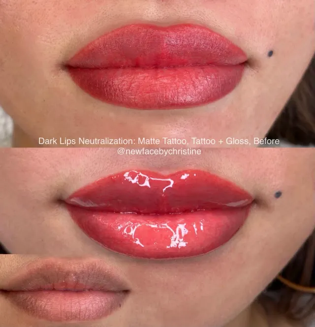 Dark Lips Neutralization result by New Face by Christine, NYC — photo 144