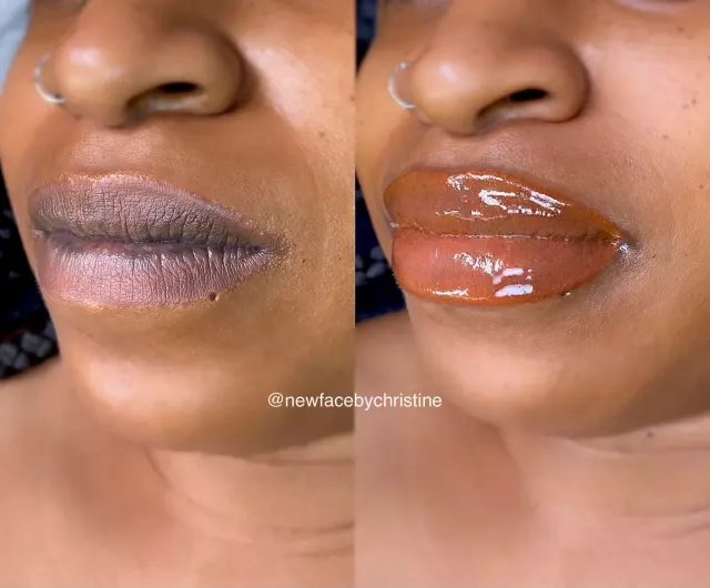 Dark Lips Neutralization result by New Face by Christine, NYC — photo 146