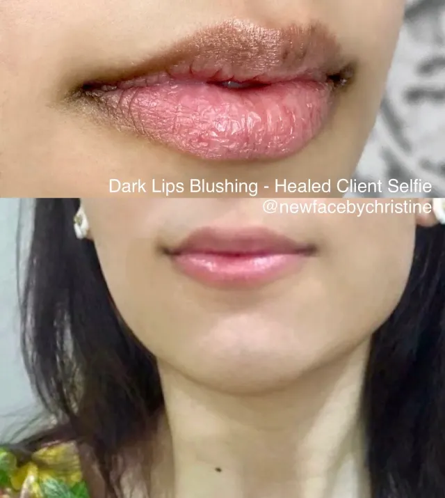 Dark Lips Neutralization result by New Face by Christine, NYC — photo 153