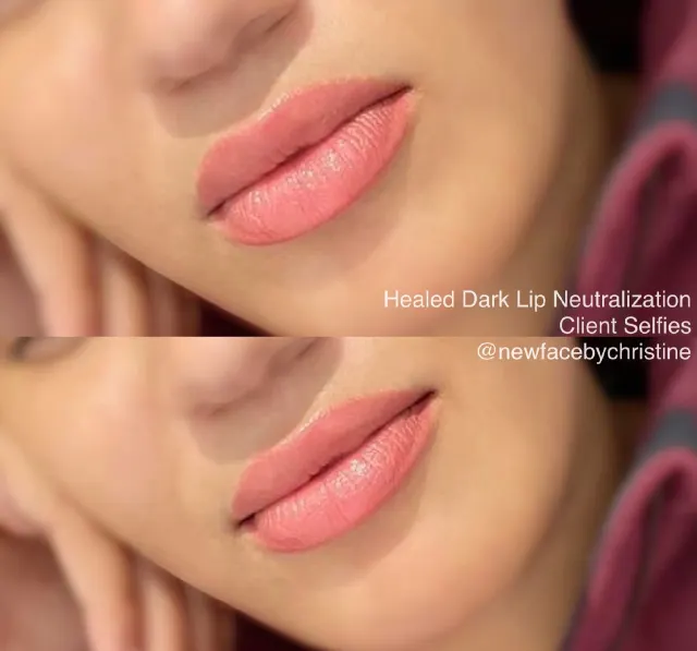 Dark Lips Neutralization result by New Face by Christine, NYC — photo 156