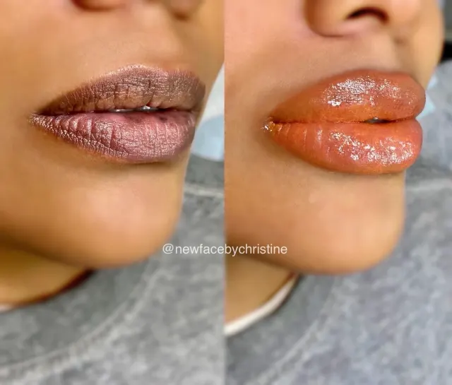 Dark Lips Neutralization result by New Face by Christine, NYC — photo 158