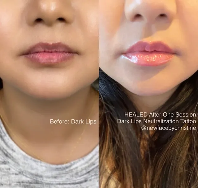 Dark Lips Neutralization result by New Face by Christine, NYC — photo 159