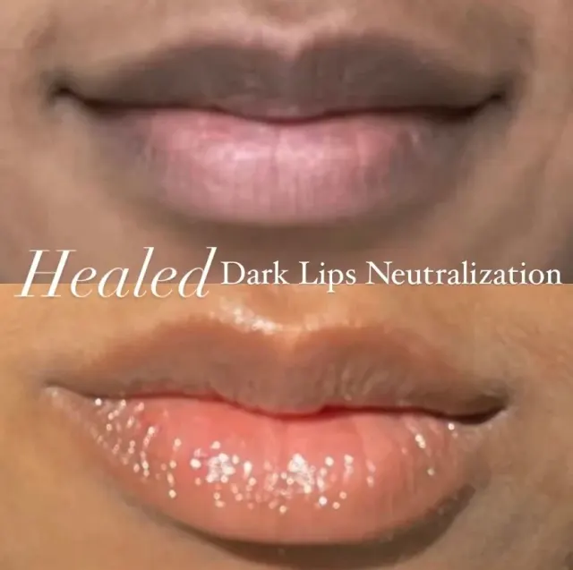 Dark Lips Neutralization result by New Face by Christine, NYC — photo 160