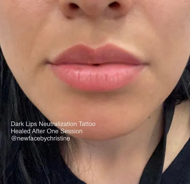 Dark Lips Neutralization result by New Face by Christine, NYC — photo 161