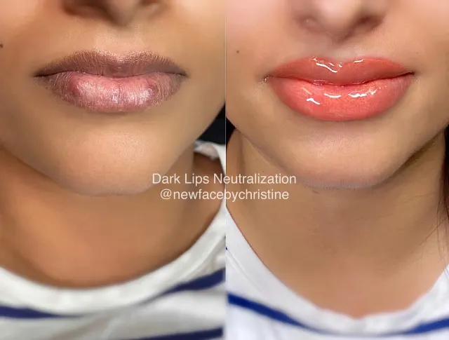 Dark Lips Neutralization result by New Face by Christine, NYC — photo 162
