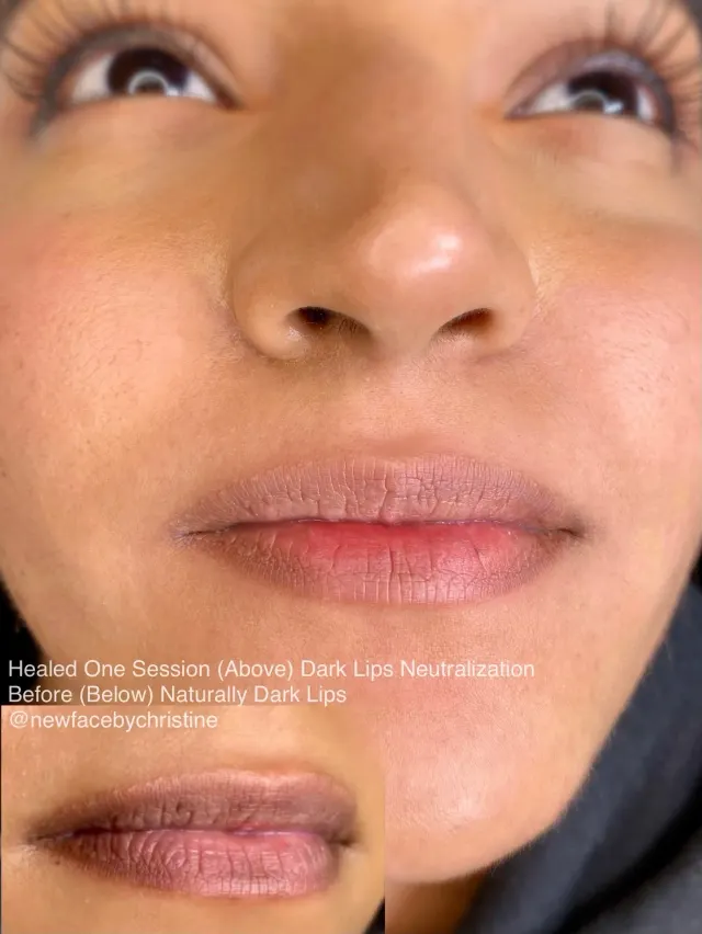 Dark Lips Neutralization result by New Face by Christine, NYC — photo 164