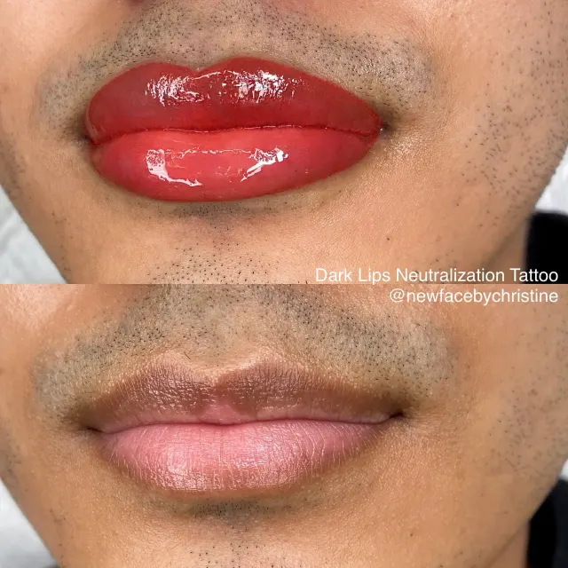 Dark Lips Neutralization result by New Face by Christine, NYC — photo 166