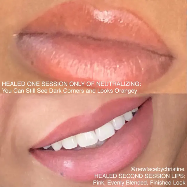 Dark Lips Neutralization result by New Face by Christine, NYC — photo 167