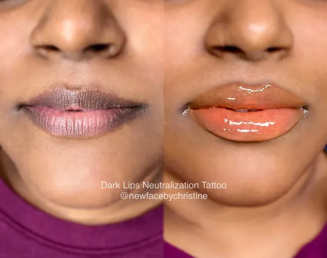 Dark Lips Neutralization result by New Face by Christine, NYC — photo 169