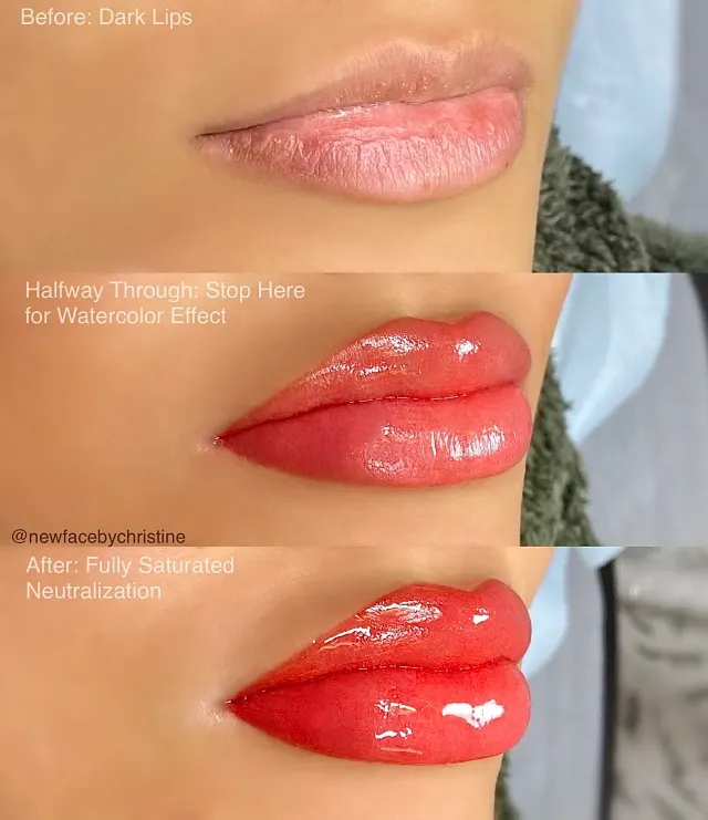 Dark Lips Neutralization result by New Face by Christine, NYC — photo 172