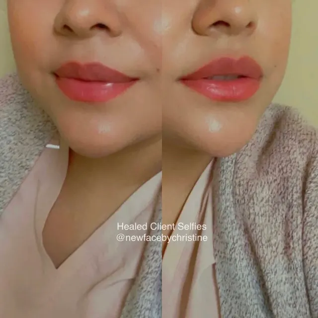 Dark Lips Neutralization result by New Face by Christine, NYC — photo 174