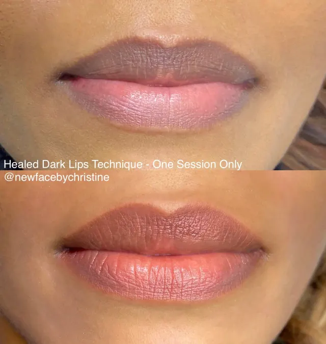 Dark Lips Neutralization result by New Face by Christine, NYC — photo 175