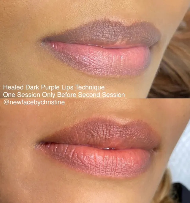Dark Lips Neutralization result by New Face by Christine, NYC — photo 176
