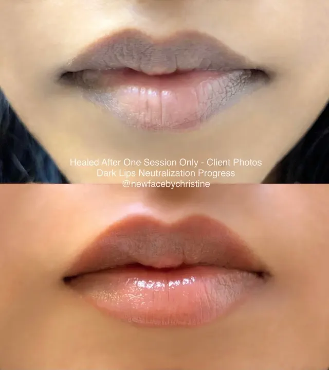 Dark Lips Neutralization result by New Face by Christine, NYC — photo 177