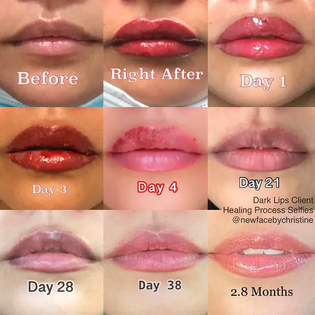Dark Lips Neutralization result by New Face by Christine, NYC — photo 178