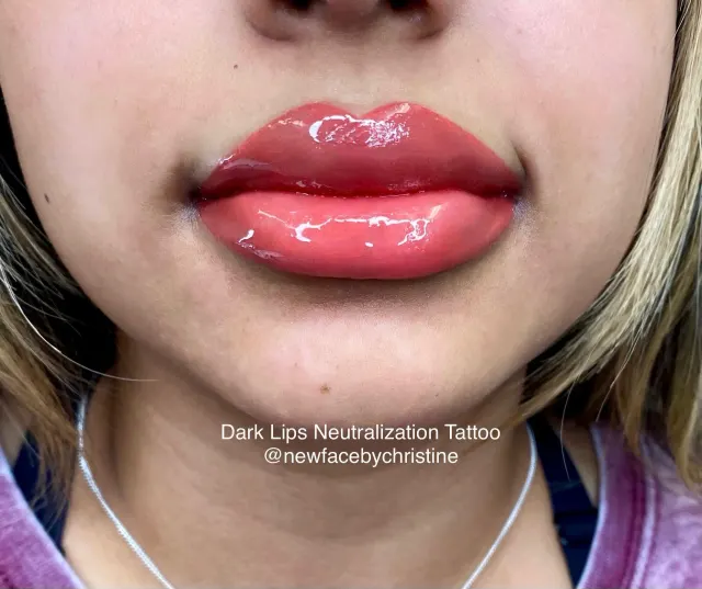 Dark Lips Neutralization result by New Face by Christine, NYC — photo 179
