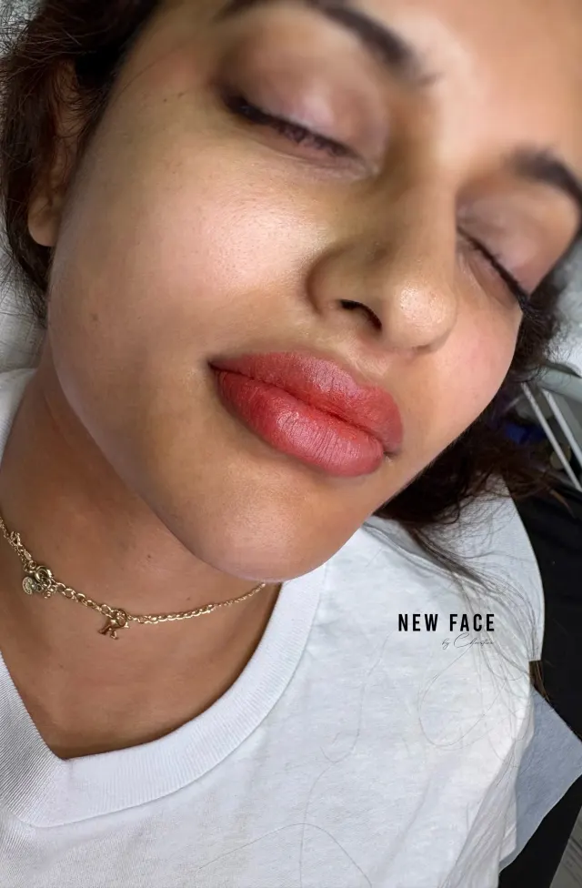 Dark Lips Neutralization result by New Face by Christine, NYC — photo 180