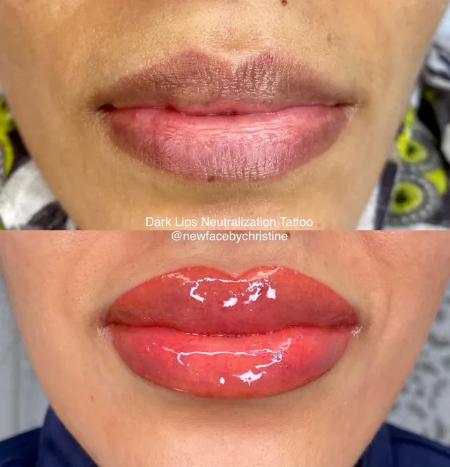 Dark Lips Neutralization result by New Face by Christine, NYC — photo 181