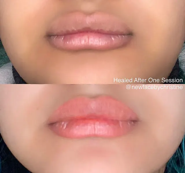 Dark Lips Neutralization result by New Face by Christine, NYC — photo 182
