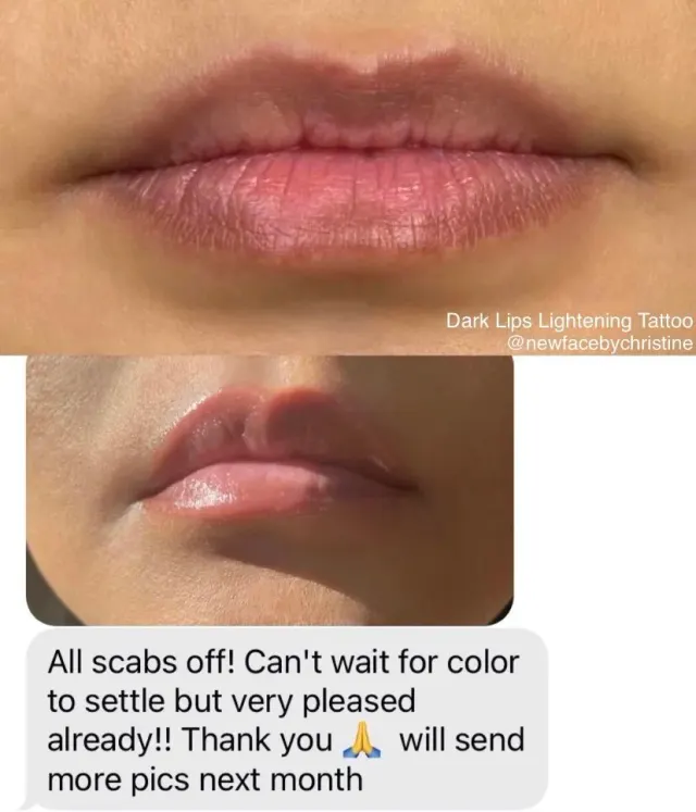 Dark Lips Neutralization result by New Face by Christine, NYC — photo 183