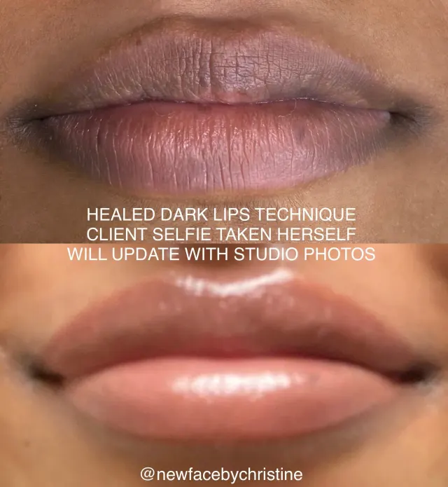 Dark Lips Neutralization result by New Face by Christine, NYC — photo 184
