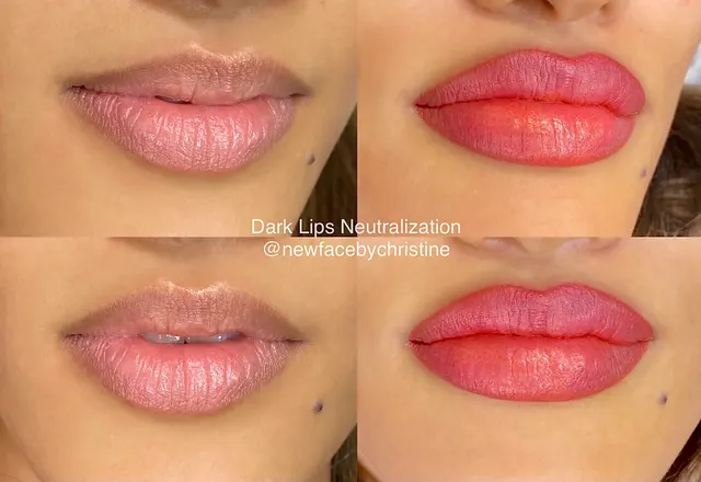 Dark Lips Neutralization result by New Face by Christine, NYC — photo 185