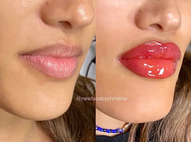 Dark Lips Neutralization result by New Face by Christine, NYC — photo 186