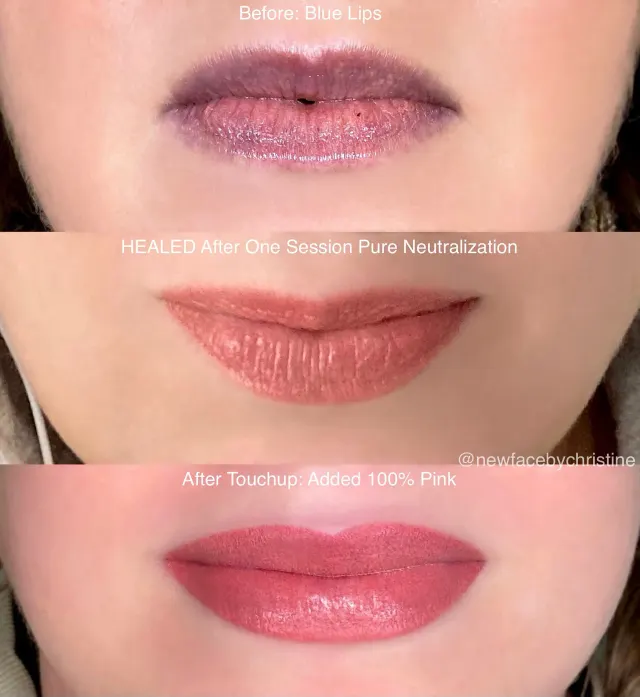 Dark Lips Neutralization result by New Face by Christine, NYC — photo 187