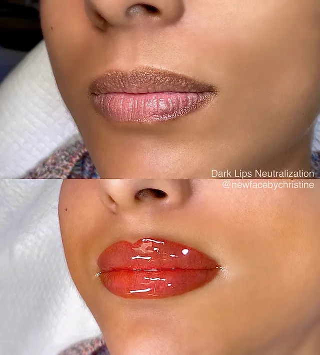 Dark Lips Neutralization result by New Face by Christine, NYC — photo 188