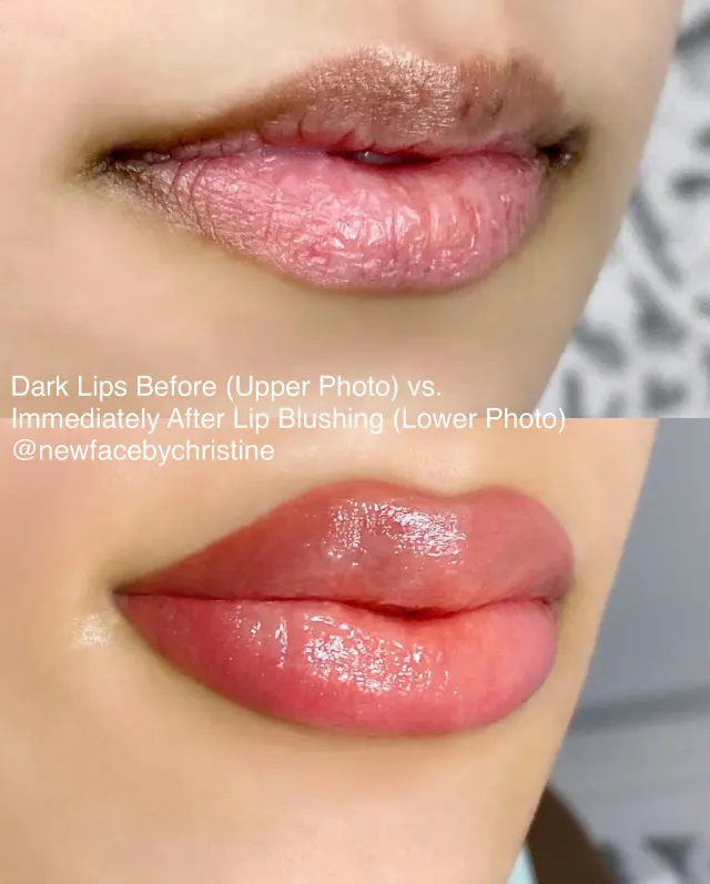 Dark Lips Neutralization result by New Face by Christine, NYC — photo 189