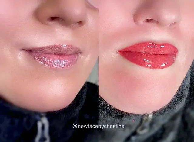 Dark Lips Neutralization result by New Face by Christine, NYC — photo 193