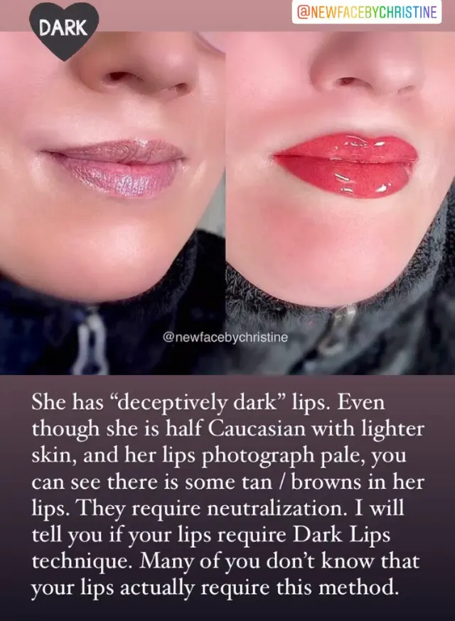 Dark Lips Neutralization result by New Face by Christine, NYC — photo 194