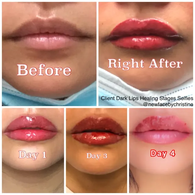 Dark Lips Neutralization result by New Face by Christine, NYC — photo 200