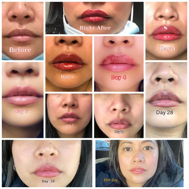 Dark Lips Neutralization result by New Face by Christine, NYC — photo 201