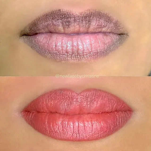 Dark Lips Neutralization result by New Face by Christine, NYC — photo 203