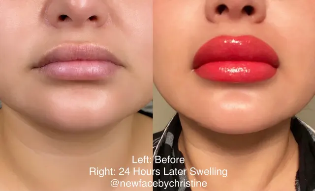 Dark Lips Neutralization result by New Face by Christine, NYC — photo 204